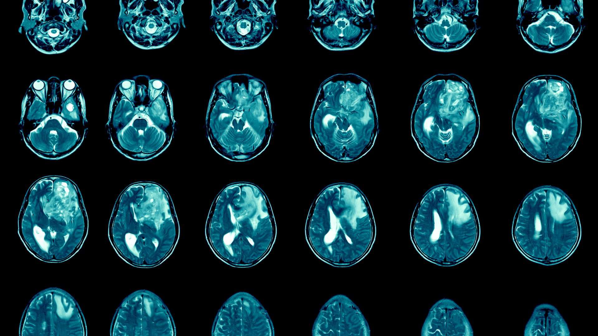 ressonância magnética do cérebro mostra tumor