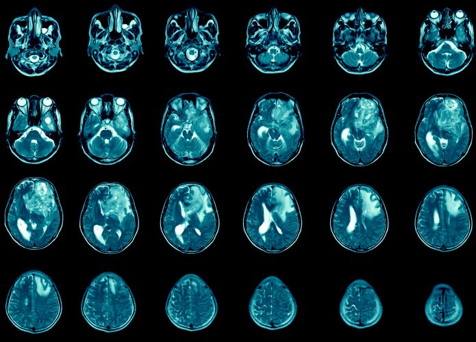ressonância magnética do cérebro mostra tumor