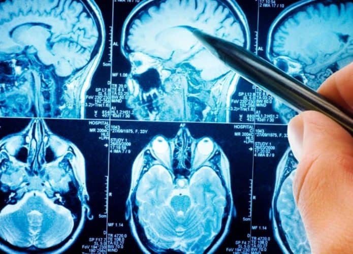 Tomografia computadorizada de um cérebro humano