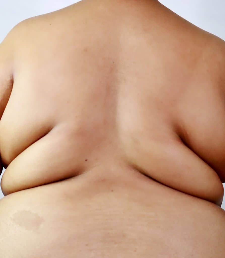 An,African,American,Woman,With,Severe,Obesity,,Back,View,Showing