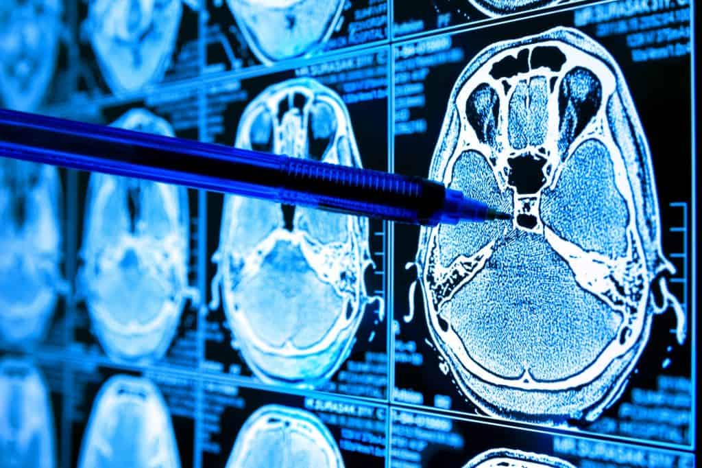 ia tumor cérebro