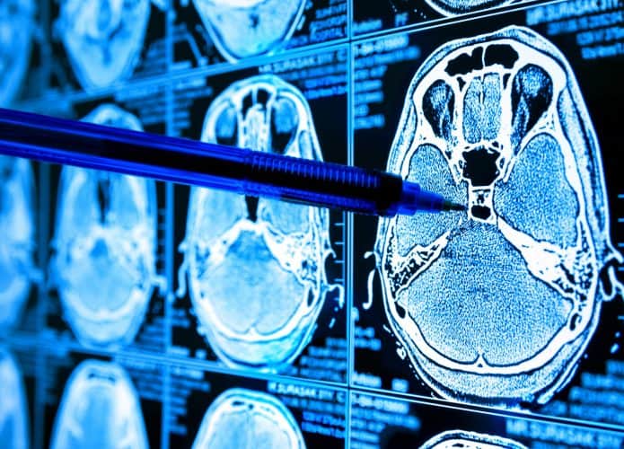 ia tumor cérebro