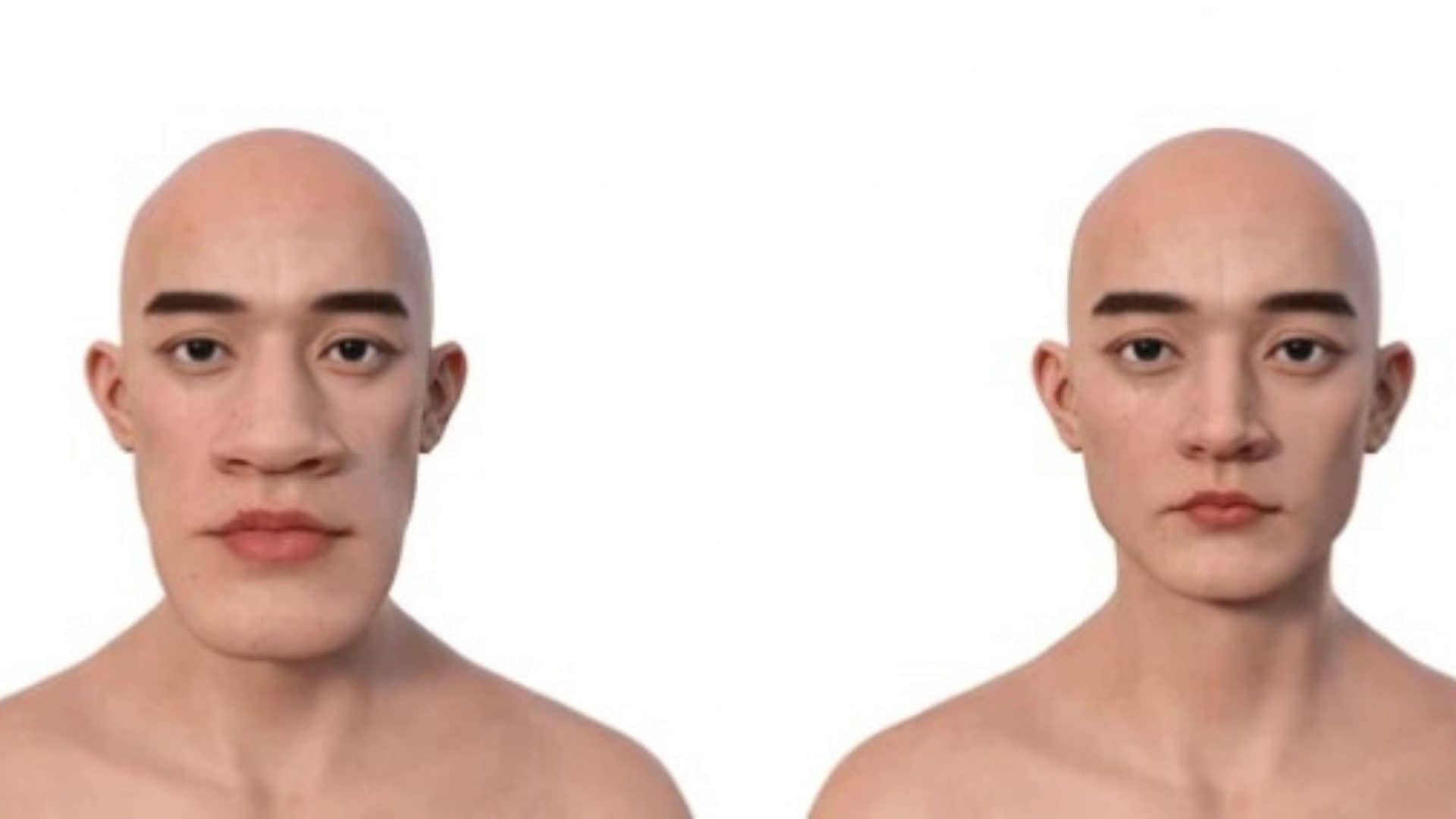 Dois rostos humanos, um normal e um com acromegalia