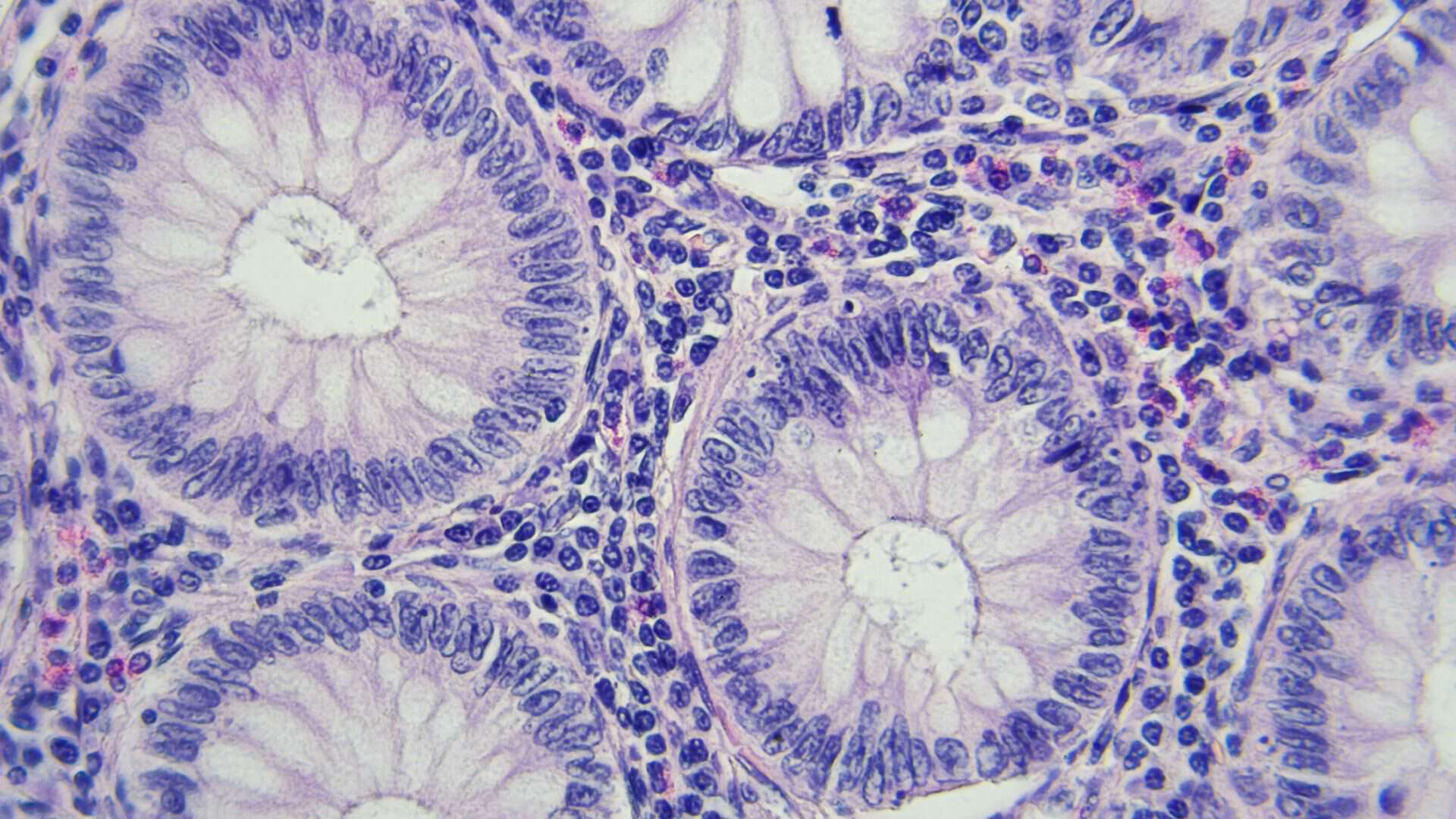 Células de câncer de cólon vista no microscópio