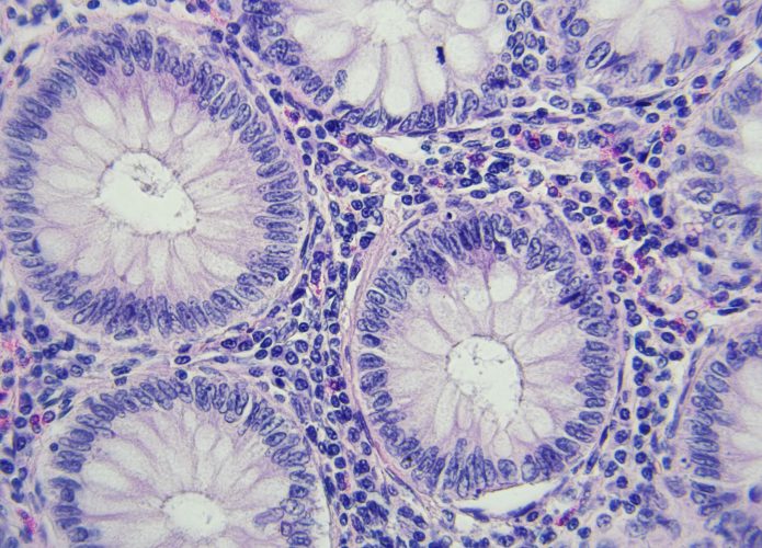 Células de câncer de cólon vista no microscópio