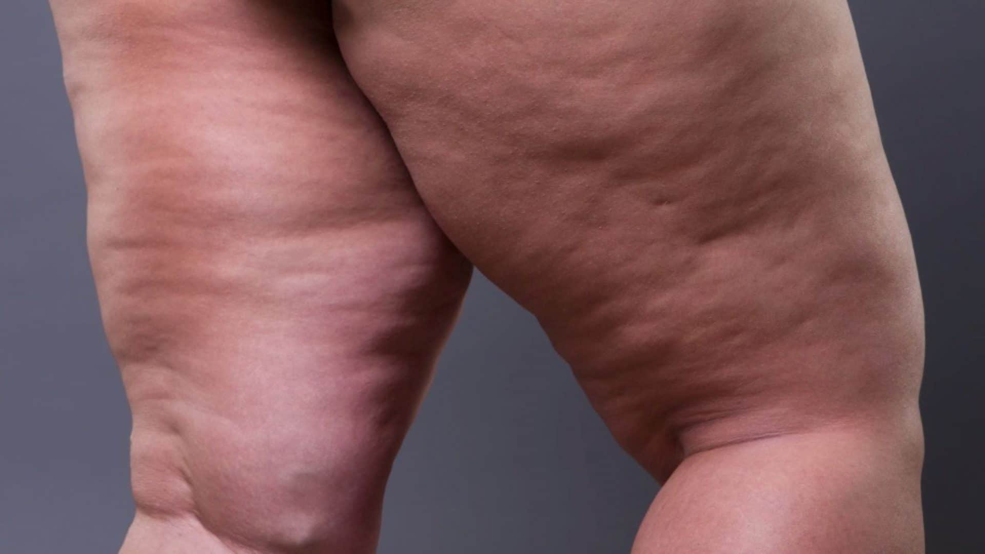 lipedema_b3af0c4a7e-1920x1080