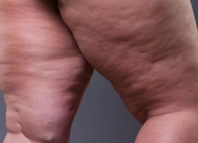 lipedema_b3af0c4a7e-695x500
