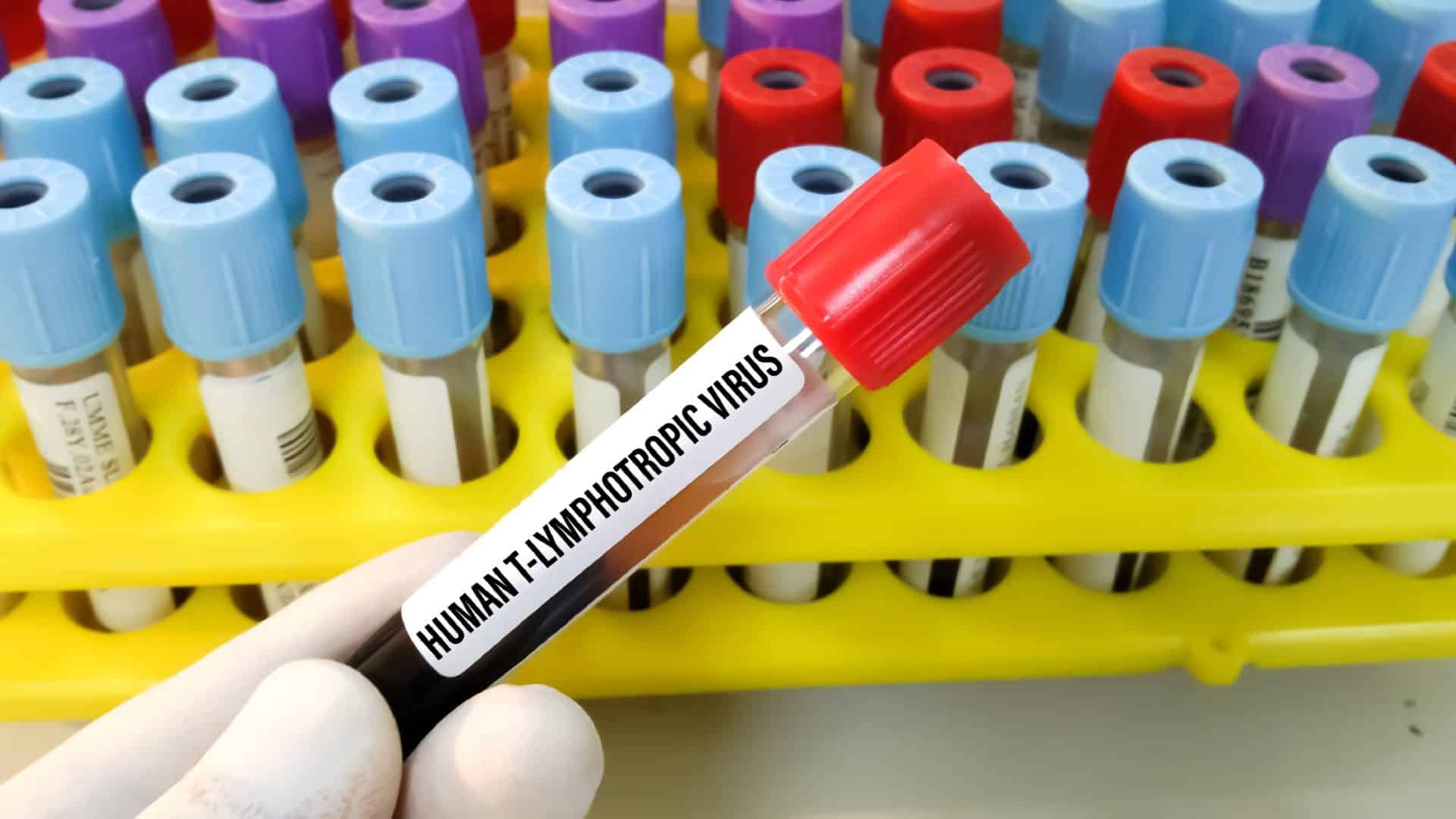 Amostra de sangue para o vírus linfotrópico humano T ou vírus da leucemia de células T humano ou teste HLTV, para diagnosticar um tipo de câncer chamado leucemia de células T adultas ou linfoma.