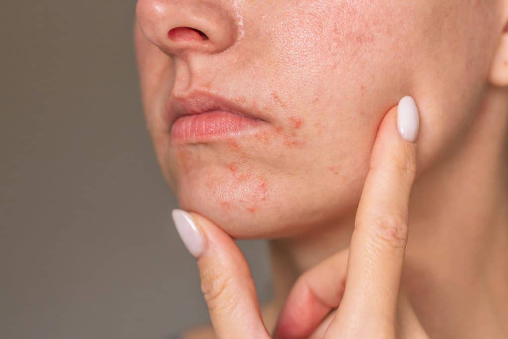Foto em close do rosto de uma mulher com dermatite perioral perto da boca.