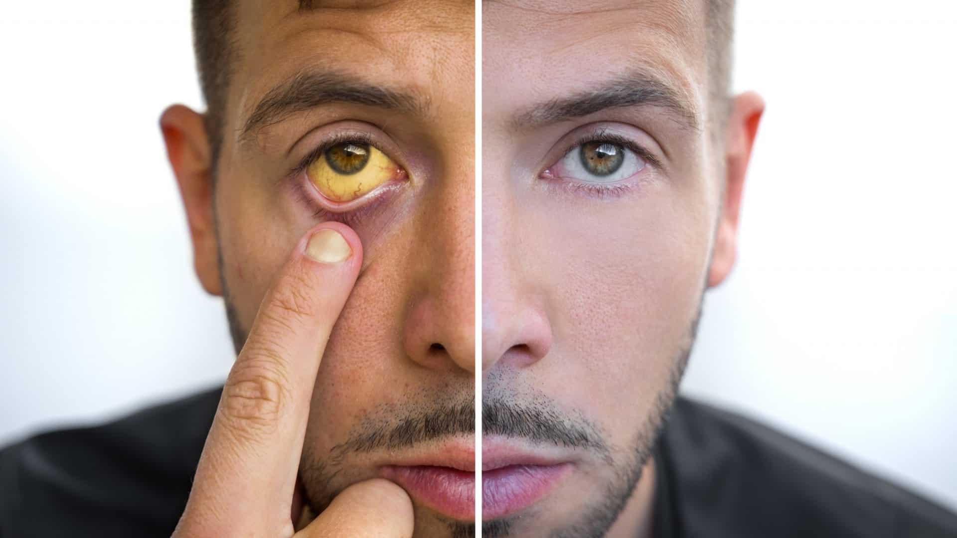 Foto mostra foto de um rosto de um homem dividida: do lado esquerdo, com seu olho amarelado; do lado direito, com seu olho saudável