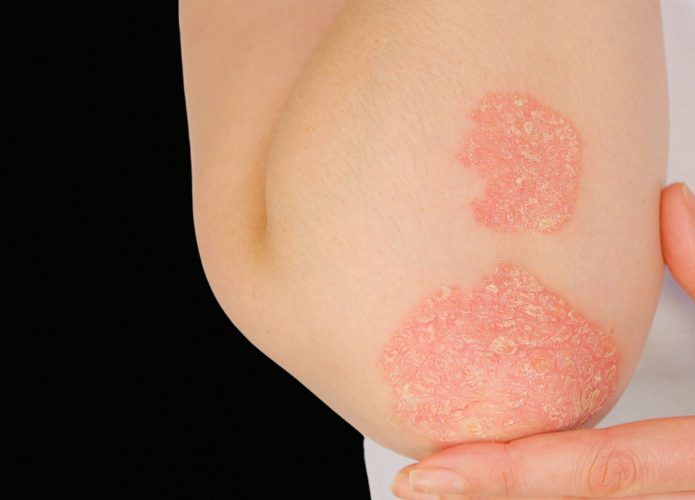 Lesões características de psoríase em cotovelo, que se repetem nos mesmos locais devido à memória inflamatória da pele