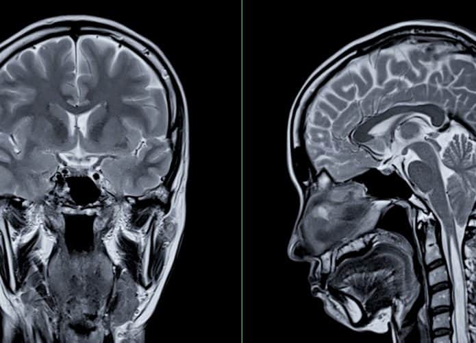Imagem mostra um exame de ressonância magnética do cérebro, que pode detectar doenças