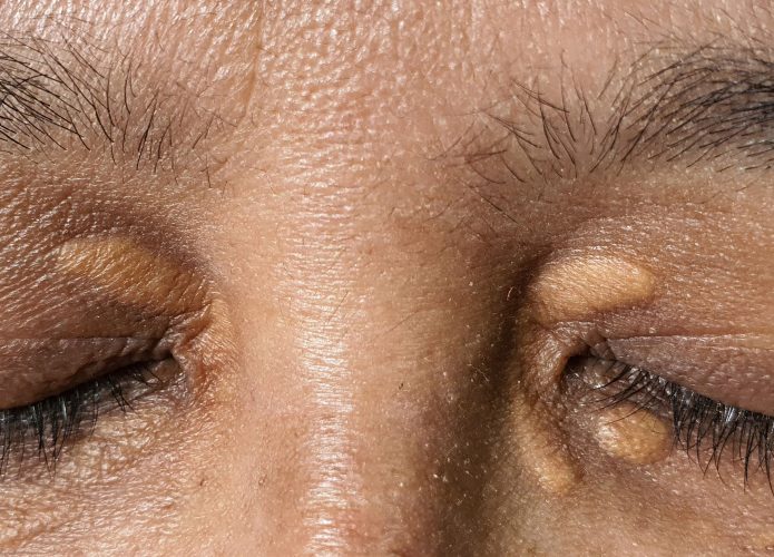 Pessoa com xantoma nos olhos