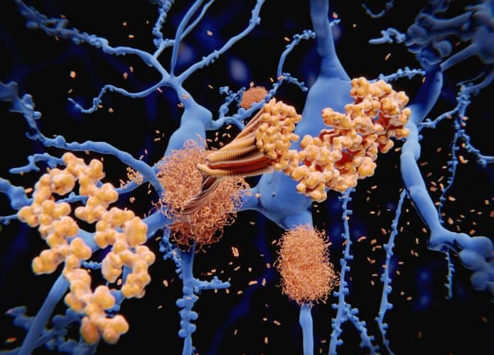 alzheimer