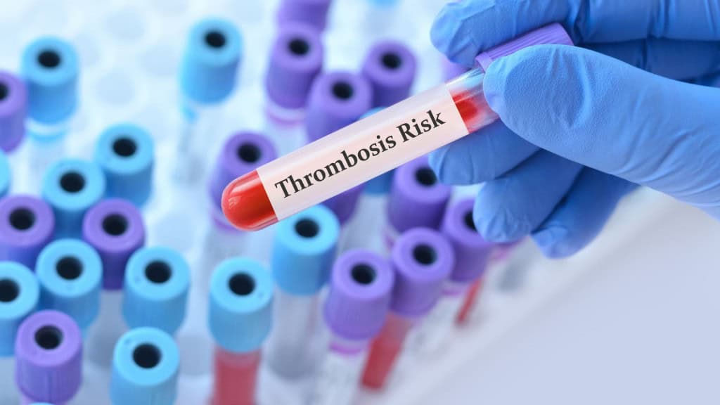 Médico segurando um tubo de amostra de sangue para teste com o teste de Risco de Trombose no fundo de tubos de ensaio médicos com análises.