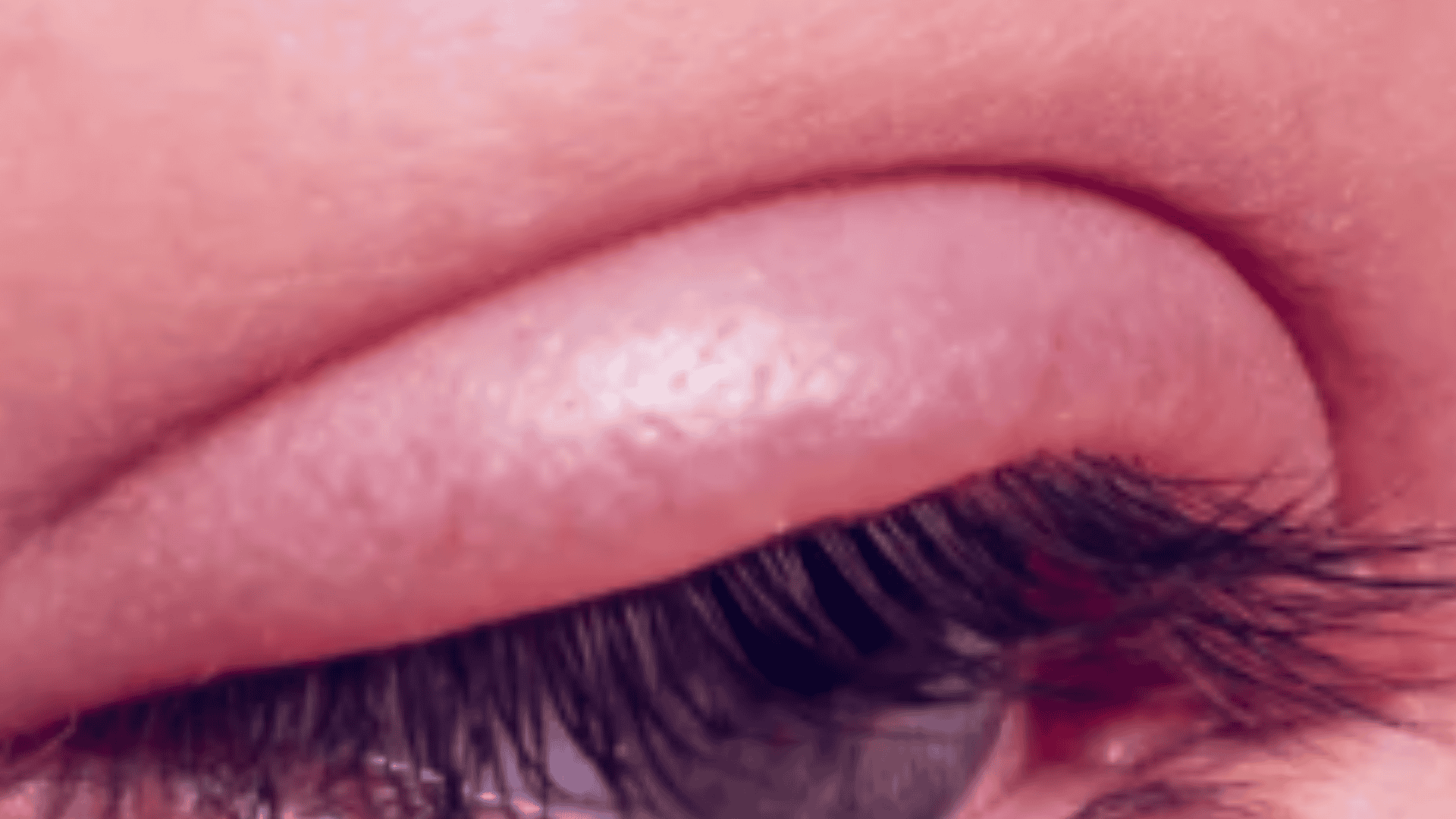 Olhos inchados