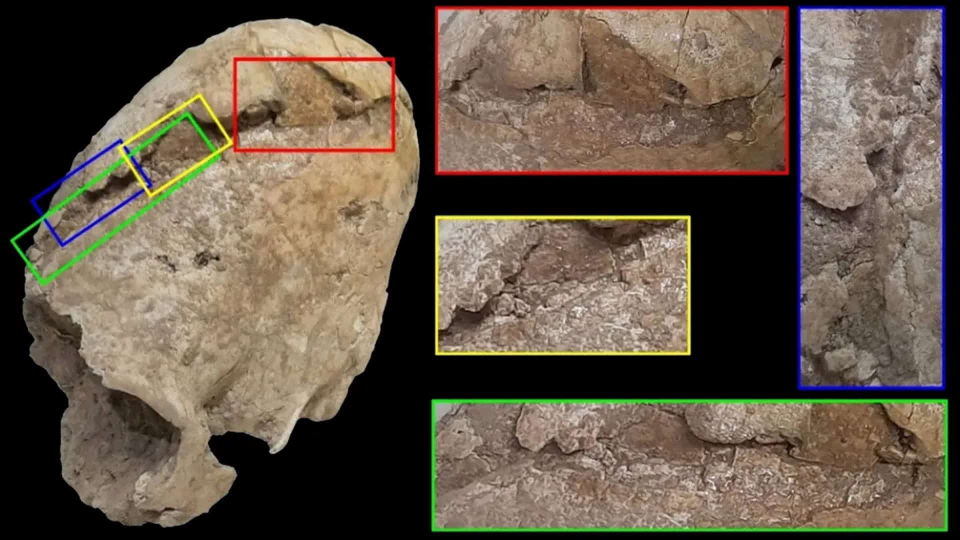 Mulher pré-histórica com cabeça cônica ferida