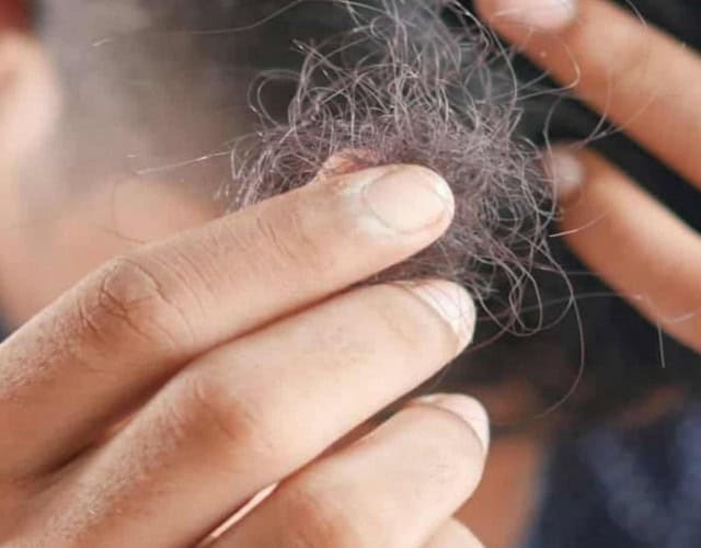 Capa - queda de cabelo