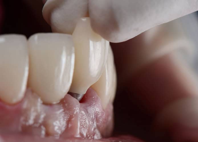 implante dentes