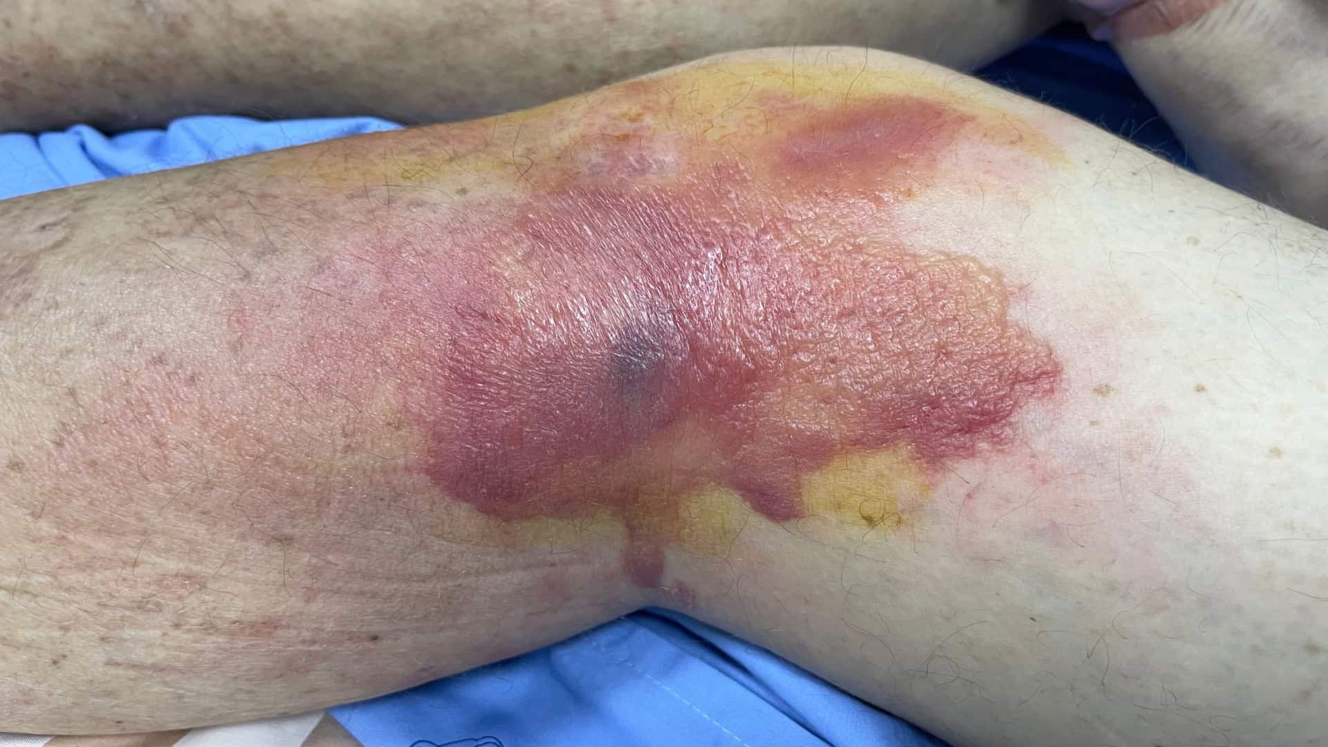 Imagem mostra mancha eritematosa bem definida com bolha hemorrágica na lateral do joelho esquerdo em um homem com celulite e choque séptico
