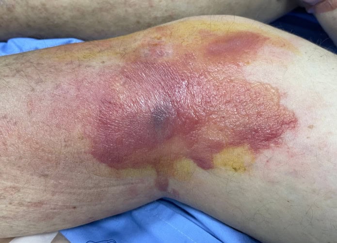 Imagem mostra mancha eritematosa bem definida com bolha hemorrágica na lateral do joelho esquerdo em um homem com celulite e choque séptico