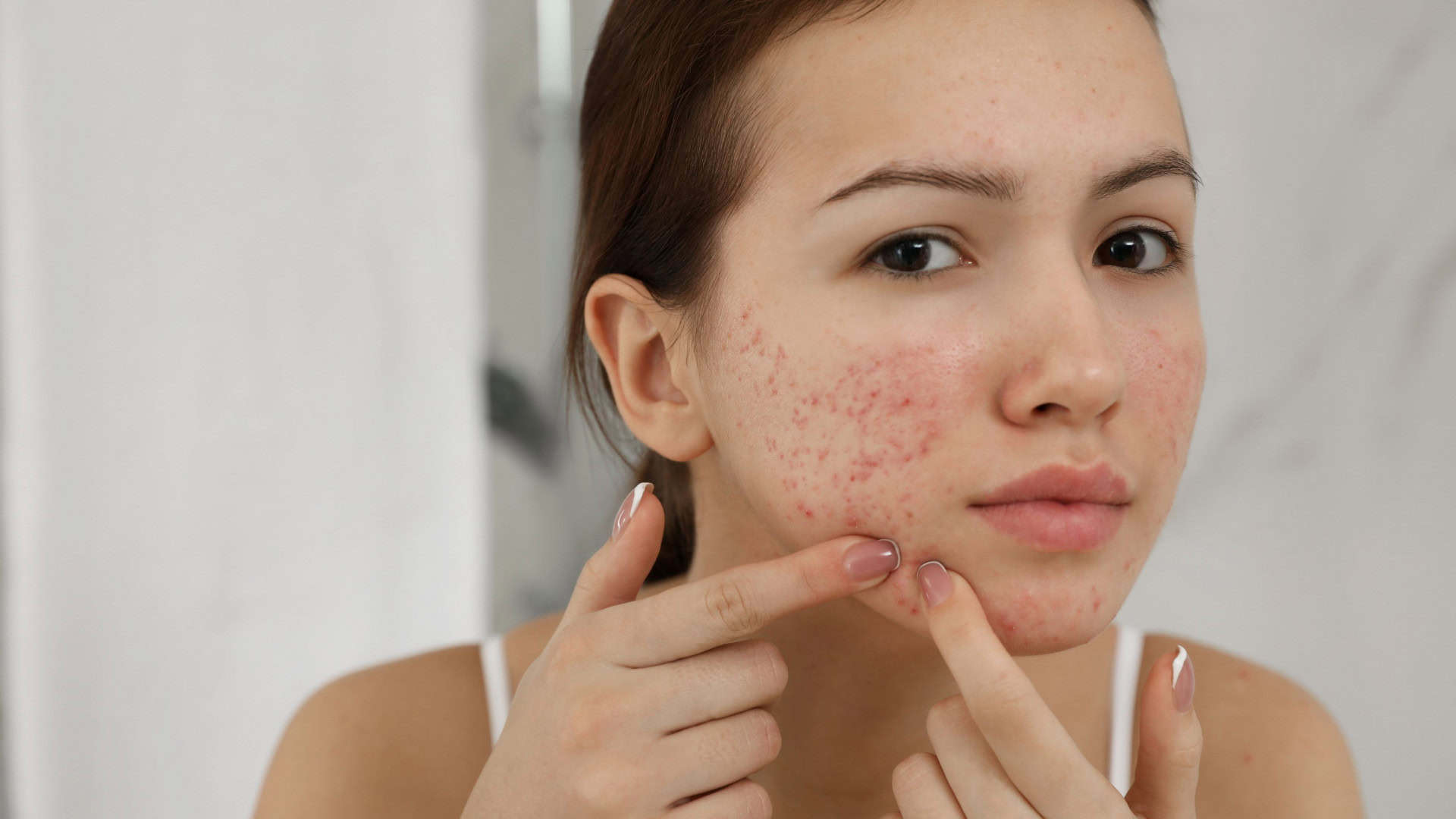 Menina adolescente com problema de acne espremendo espinha dentro de casa