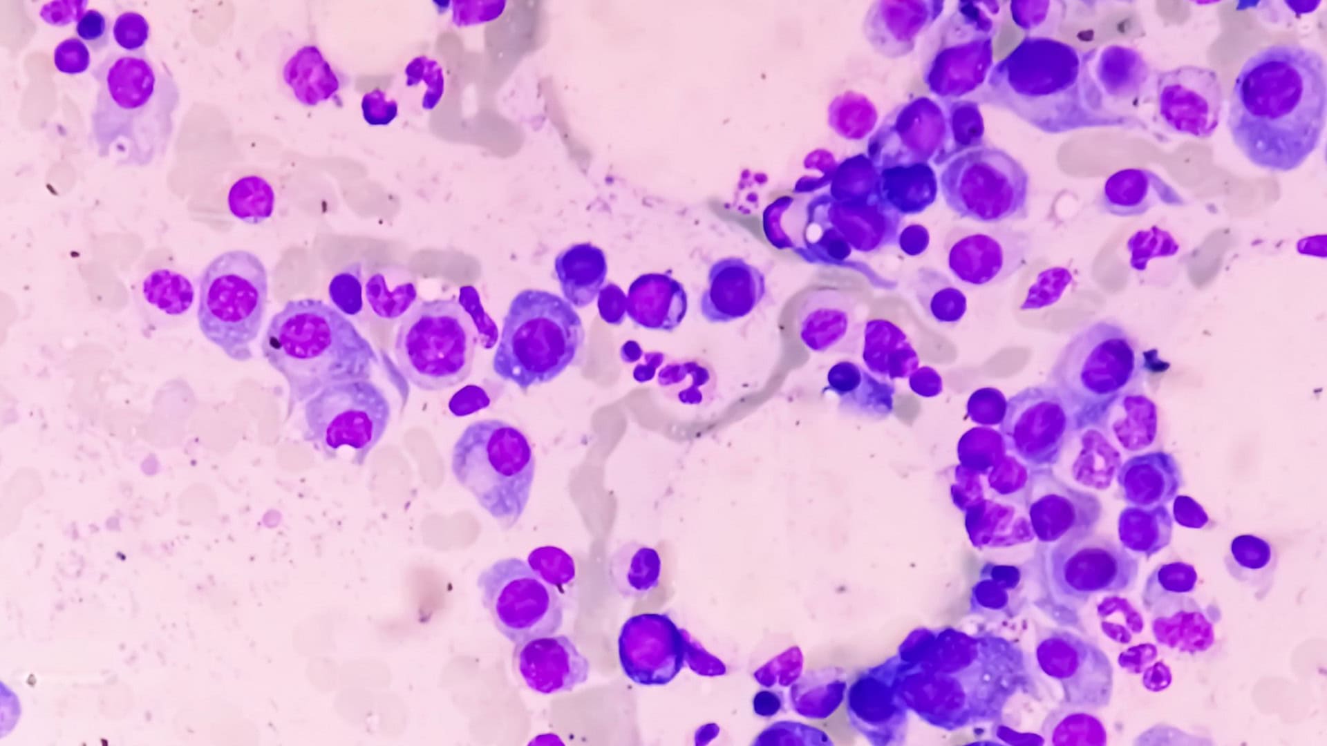 cancer