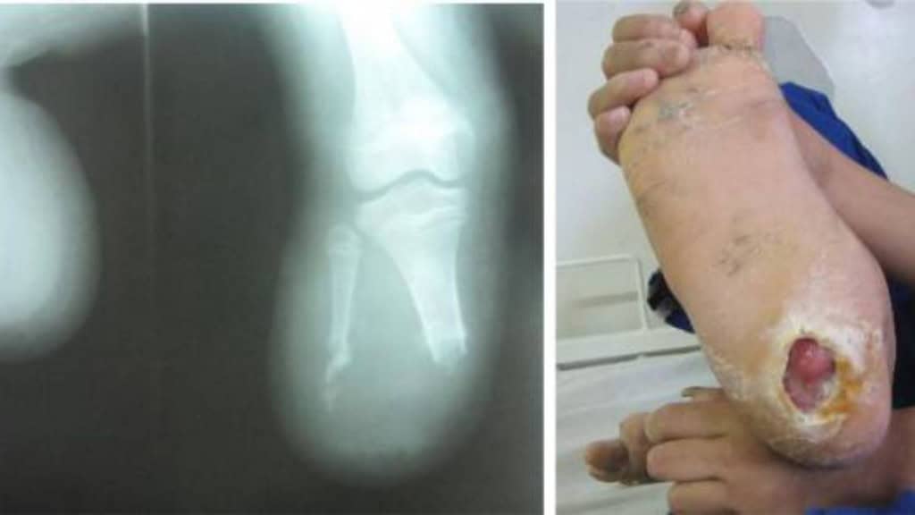 a direita imagem de radiografia de pés de menino de 12 anos, e a esquerda o menino mostra um dos pés com ferimento profundo aberto.