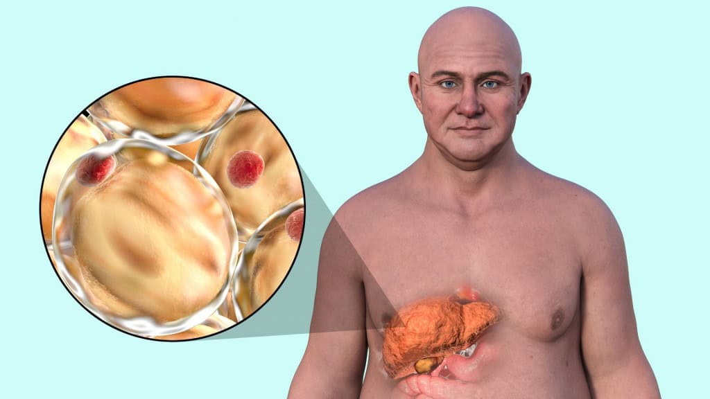 Ilustração em 3D de um homem caucasiano com pele transparente, revelando um fígado gorduroso, destacando a anatomia do fígado e o acúmulo de gordura, juntamente com uma visão de perto das células de gordura.