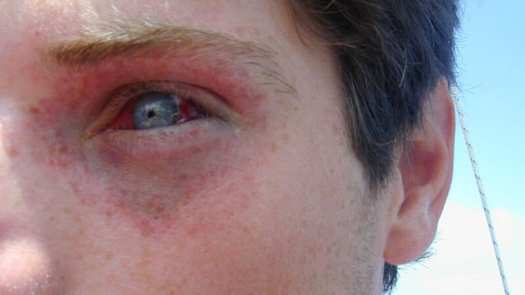 Barotrauma leve em mergulhador causado pelo aperto da máscara. Olhos e pele ao redor mostram hemorragias petequiais e subconjuntivais