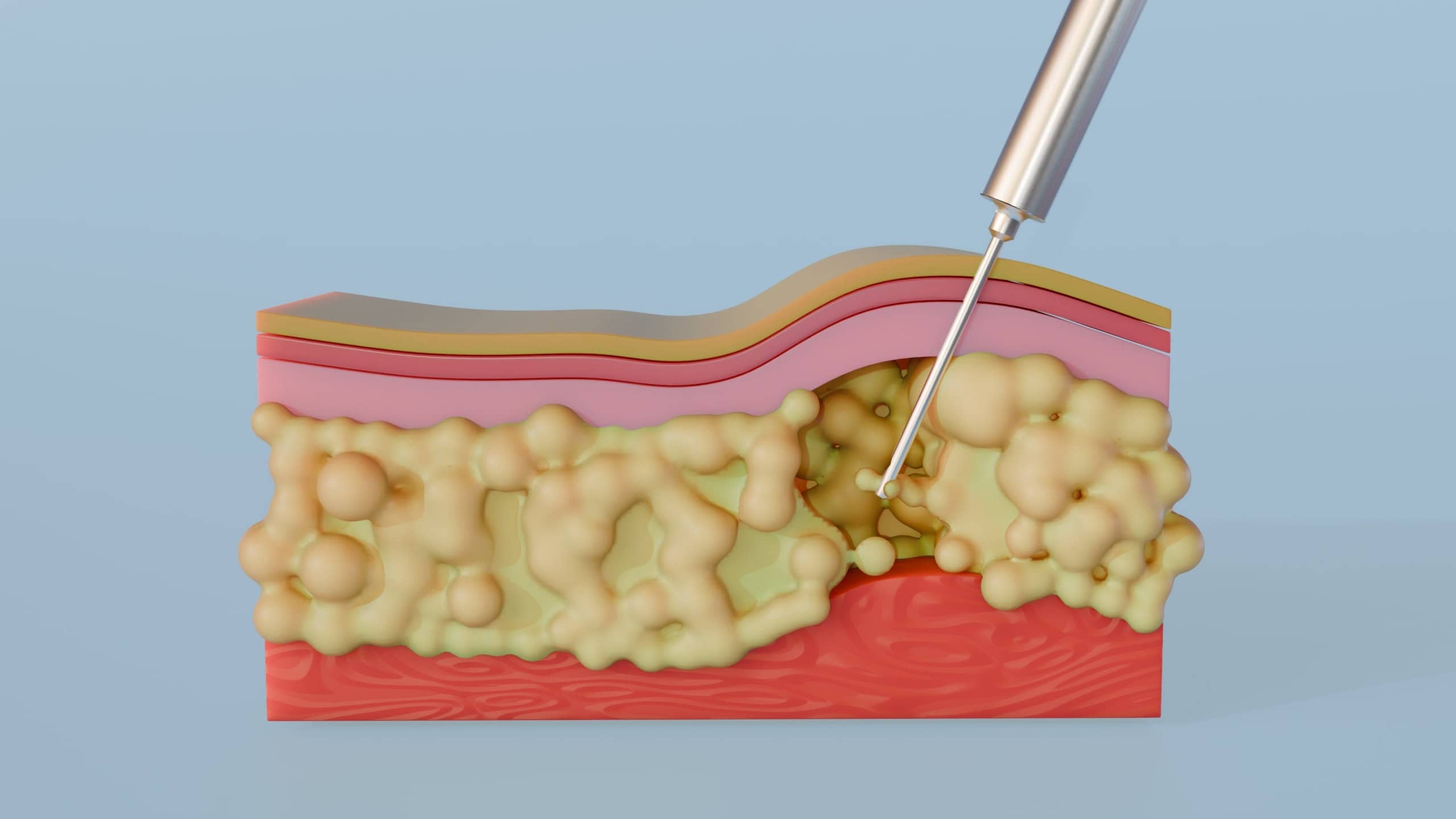 Uma renderização 3D ilustrando o processo de lipoaspiração, mostrando especificamente uma cânula removendo ativamente a gordura da camada subcutânea