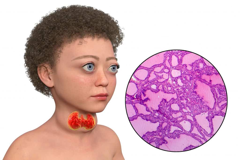 Ilustração 3D de uma criança com doença de Graves, mostrando aumento da glândula tireoide (bócio) e olhos salientes (exoftalmia), juntamente com uma micrografia óptica de um bócio tóxico