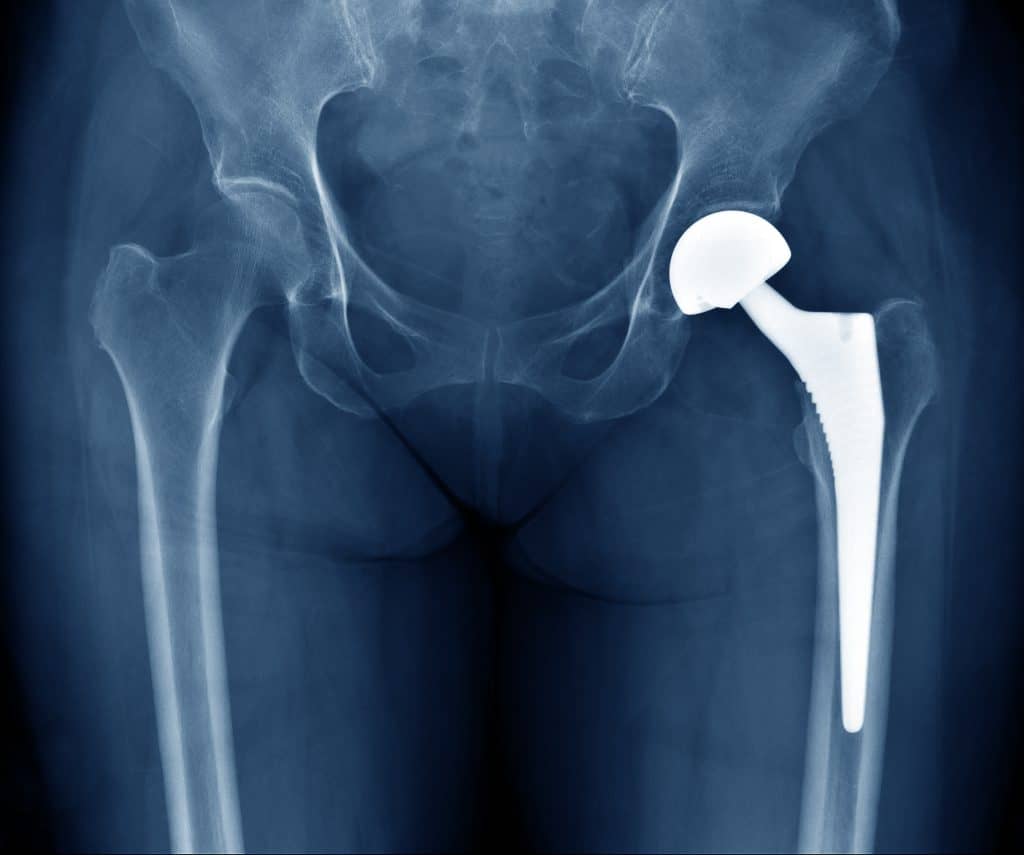 implante quadril