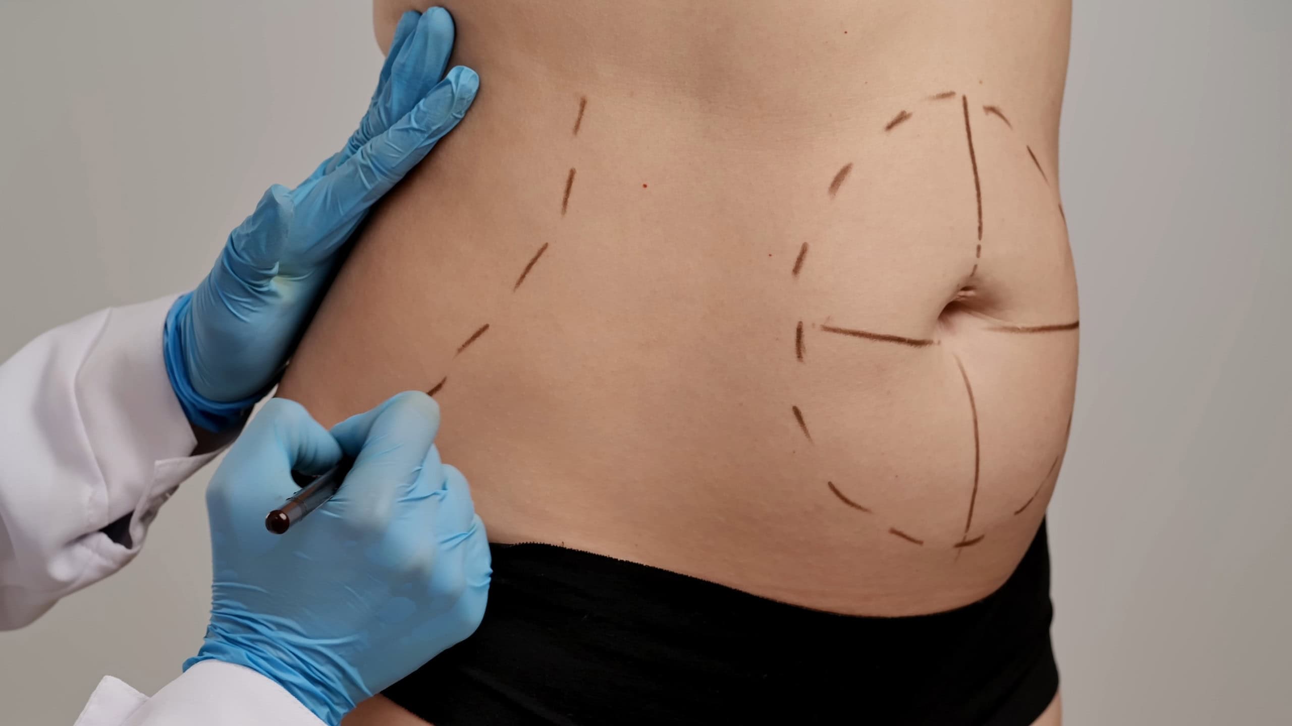 Um profissional de medicina em luvas marca linhas no abdômen de um paciente, indicando preparação para cirurgia estética. Conceito de cirurgia plástica, procedimentos de avaliação médica e saúde