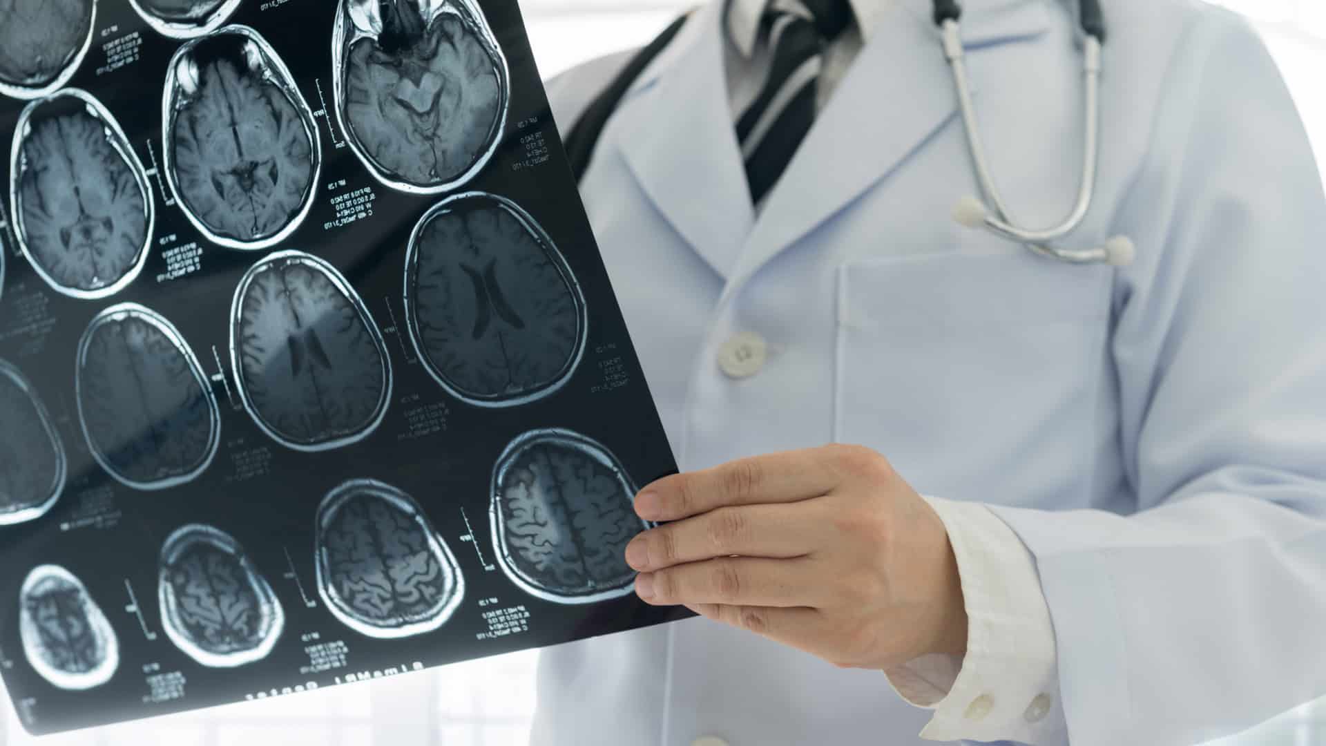 medico avc