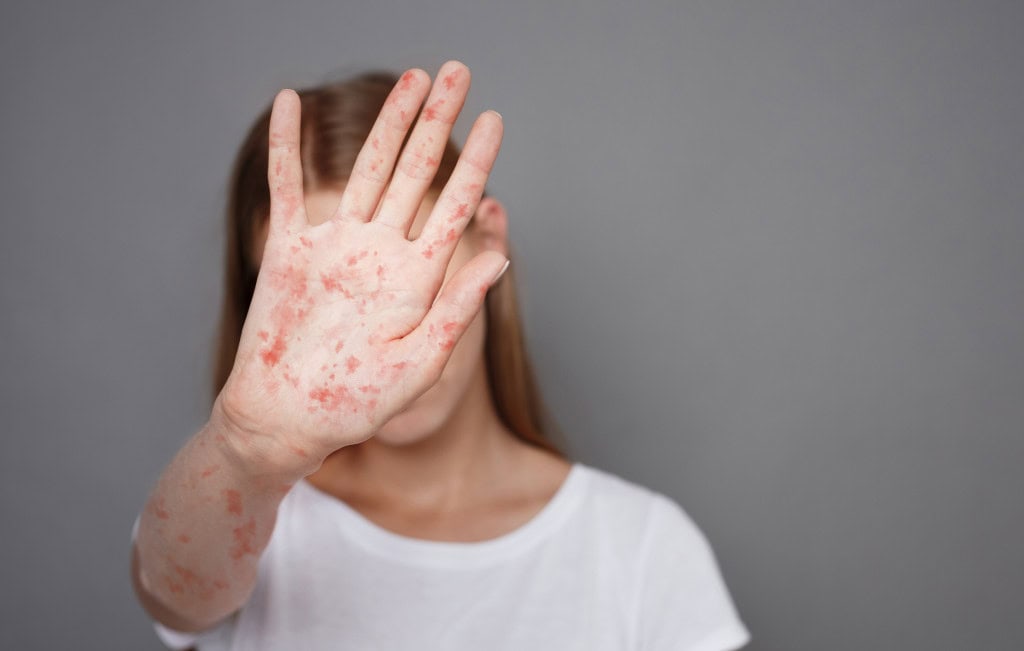 Menina com sarampo com a mão direita à frente de seu rosto
