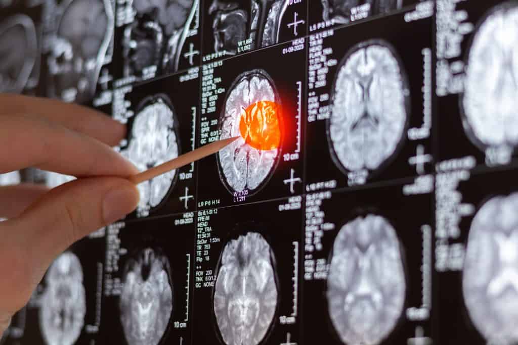 tumor cerebral