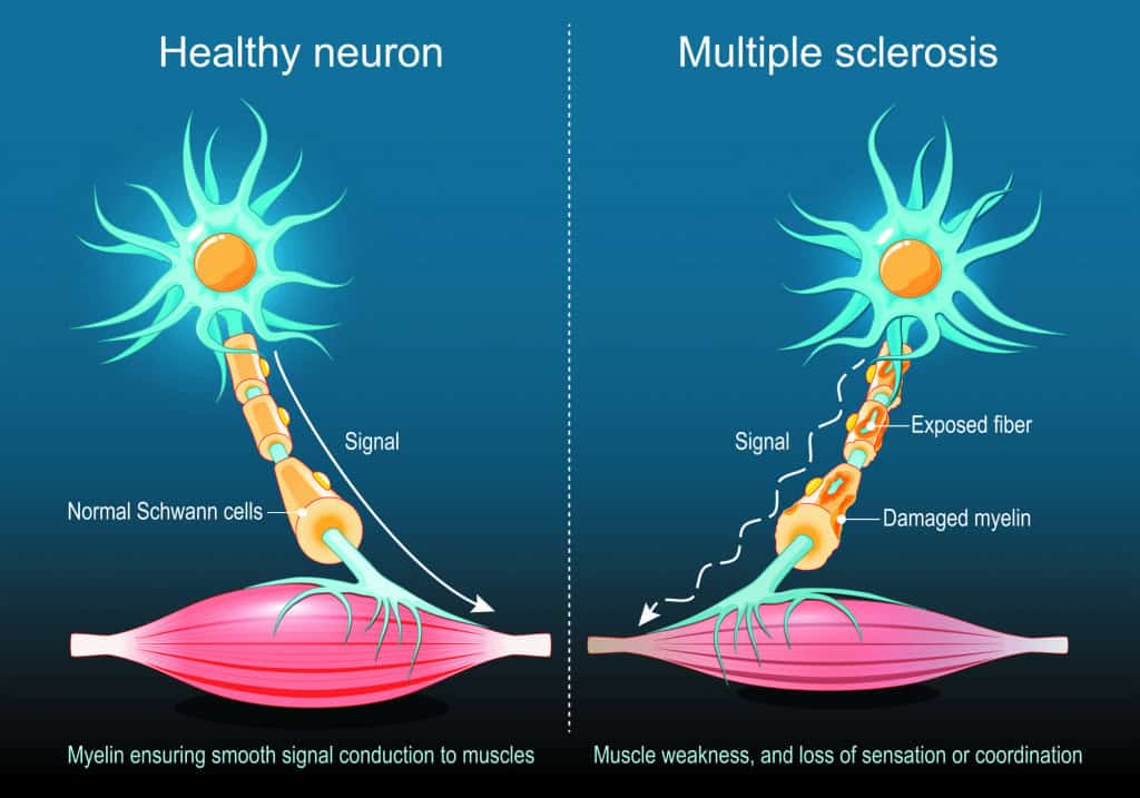 Pesquisa revela que os danos da esclerose múltipla seguem uma ordem: primeiro a mielina, depois os axônios e, mais tarde, outras células do cérebro.