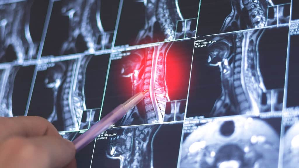 Pessoa usando caneta para apontar lesão em medula em raio-x