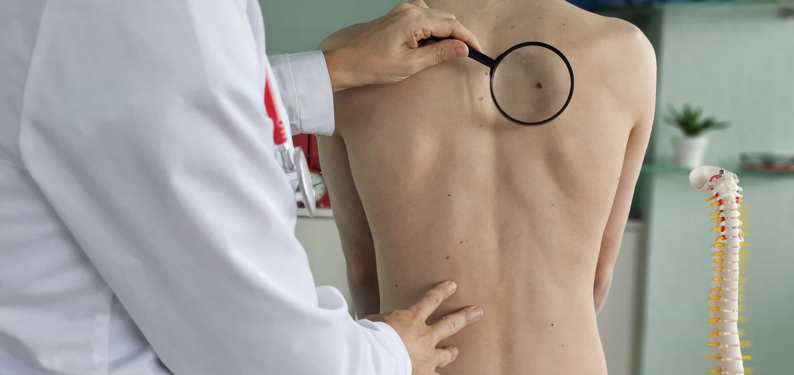 Tratamento promissor para o câncer de pele está em testes no Brasil