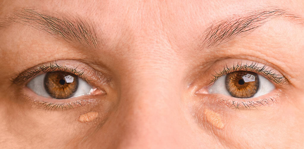 Olhos castanhos de uma mulher adulta com patologia de placas de colesterol e pálpebra caída, xantelasma.